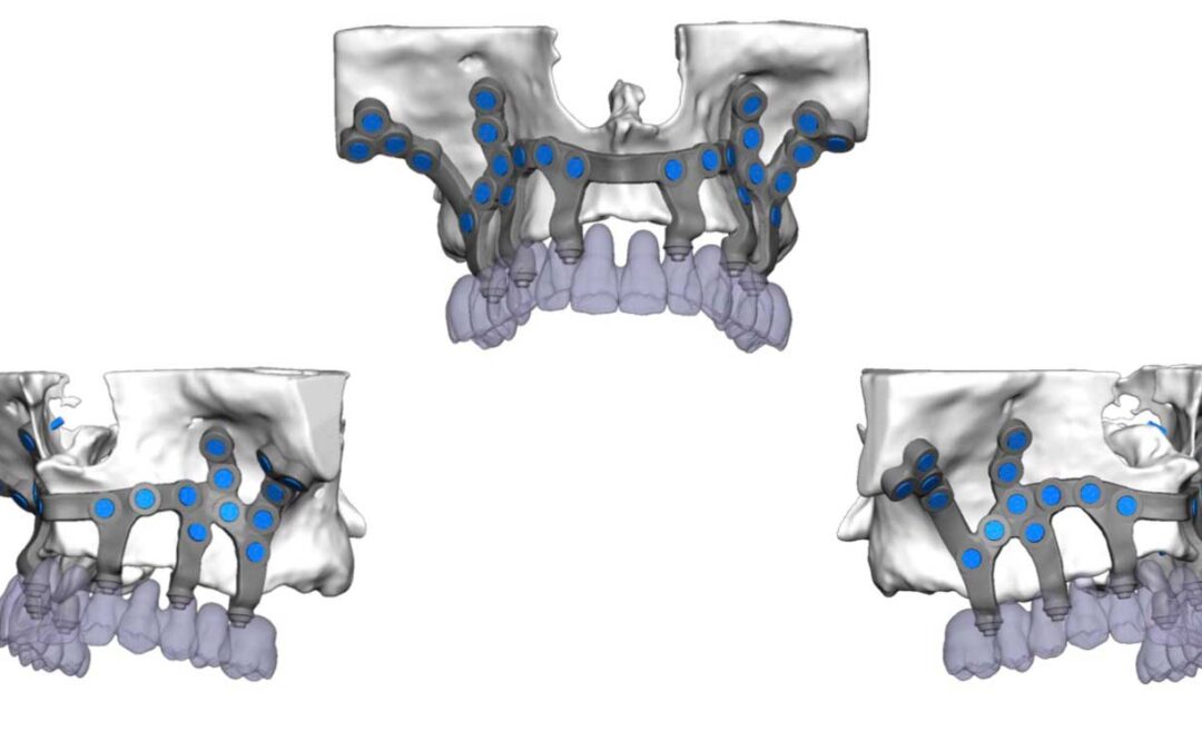 Los-Implantes-Dentales-Subperiósticos-vitoria