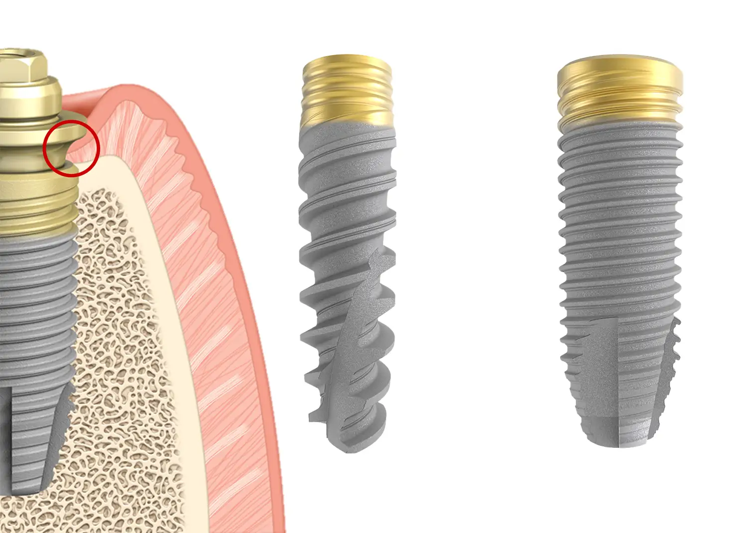 Implantes inmediatos