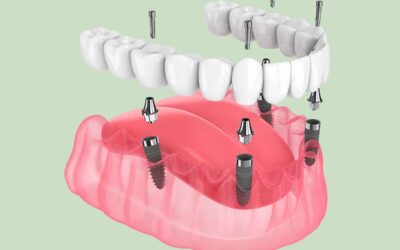 Implantes All On Four en Vitoria: Una Solución Completa para tu Sonrisa