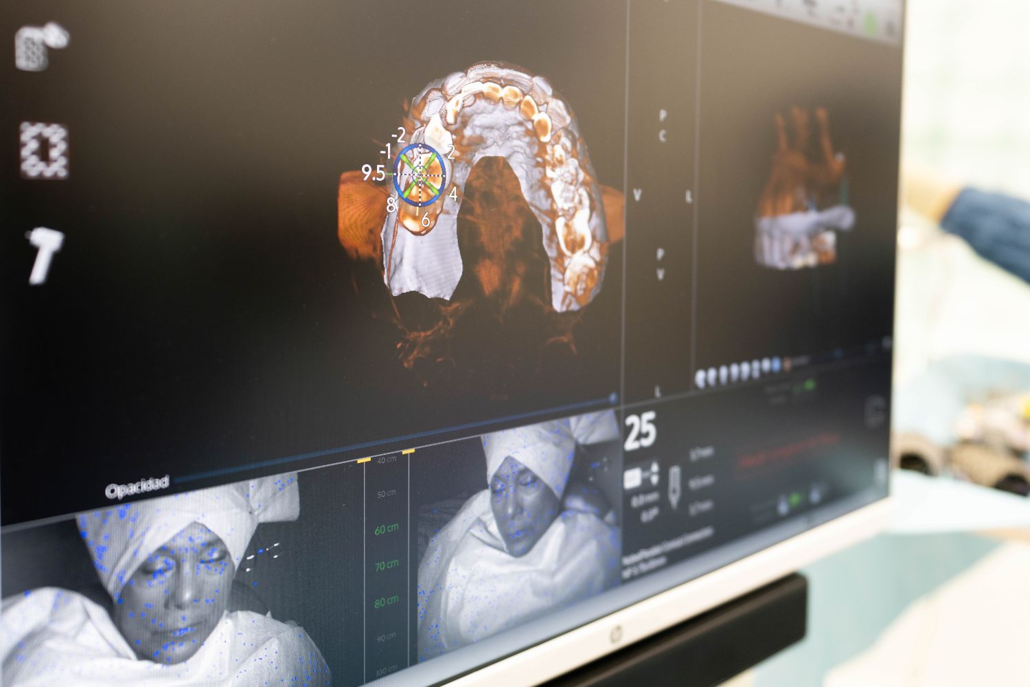 Planificación digital 3D para regeneración ósea guiada en clínica dental de Vitoria-Gasteiz