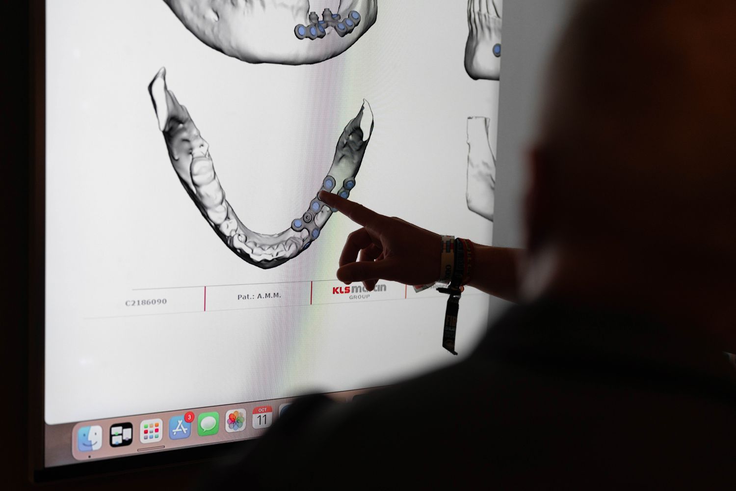 Diseño digital de cirugía guiada para regeneración ósea e implantes dentales en Vitoria-Gasteiz