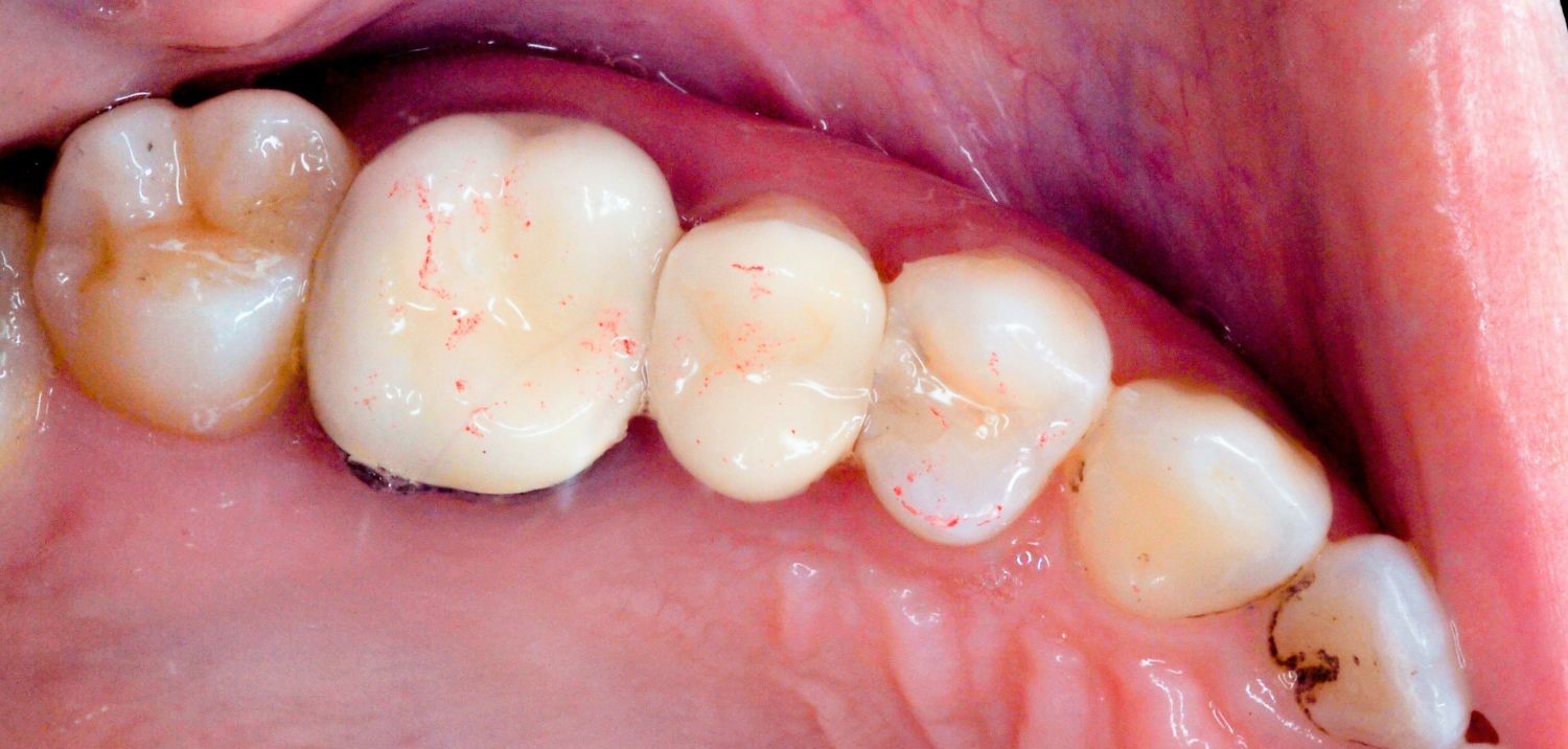 Reconstrucción dental directa con resina compuesta en molar afectado por caries