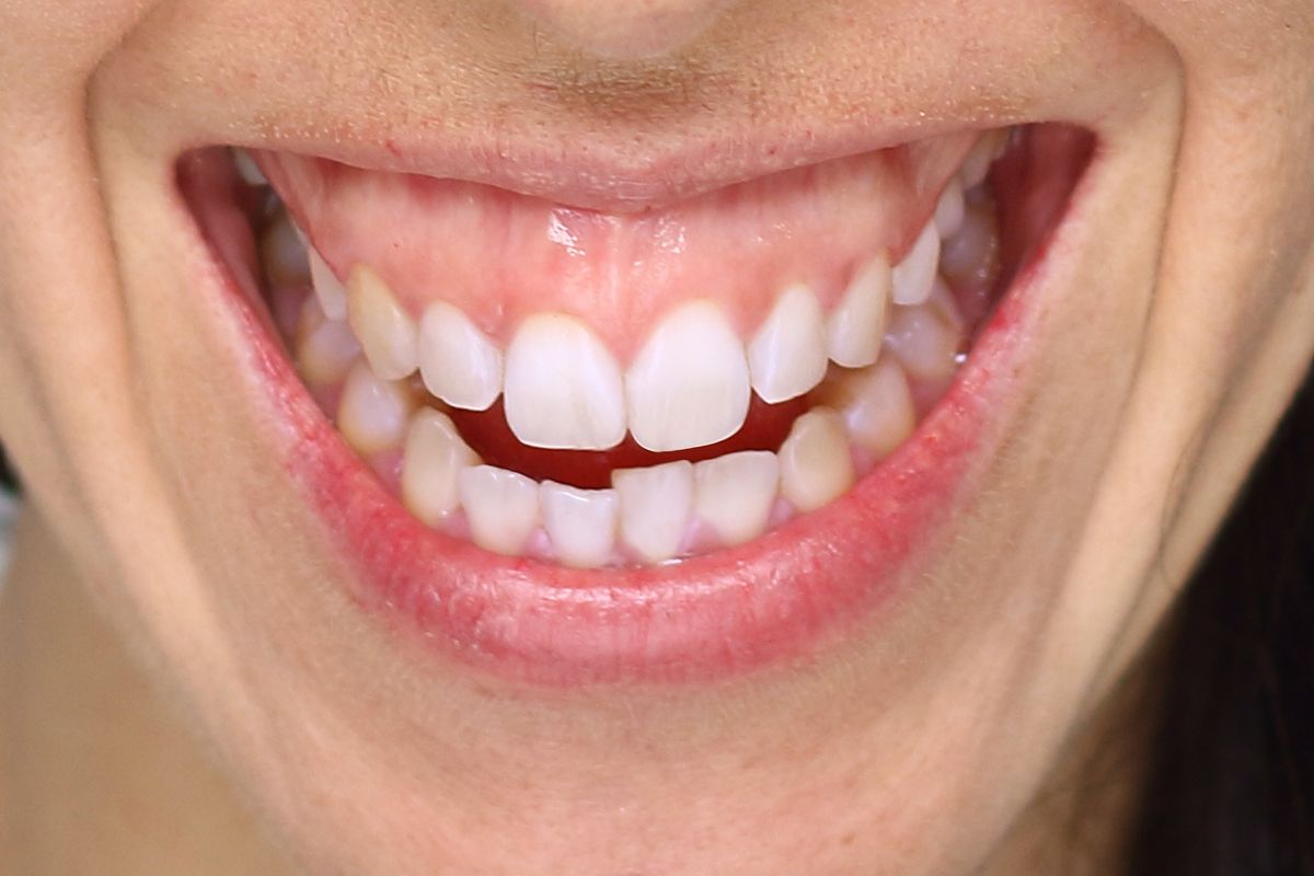 sonrisa gingival